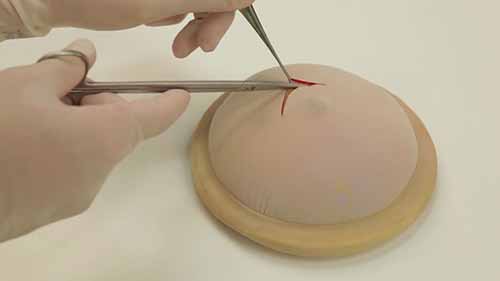 模拟乳房包块切除术